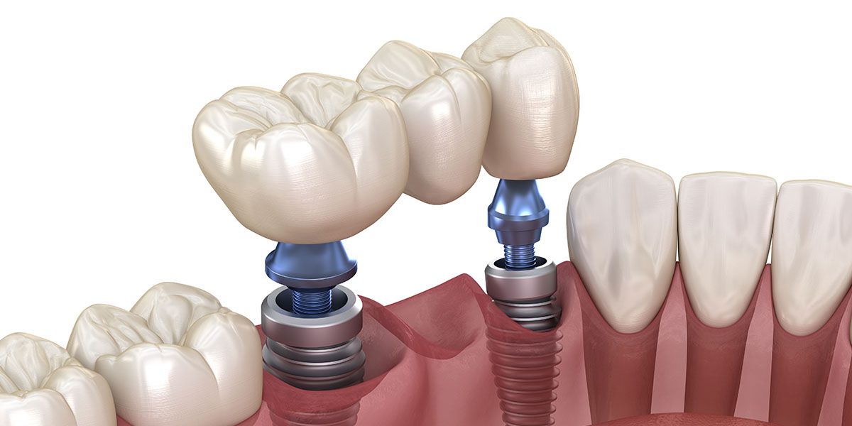 Dental Bridge| Tijuana