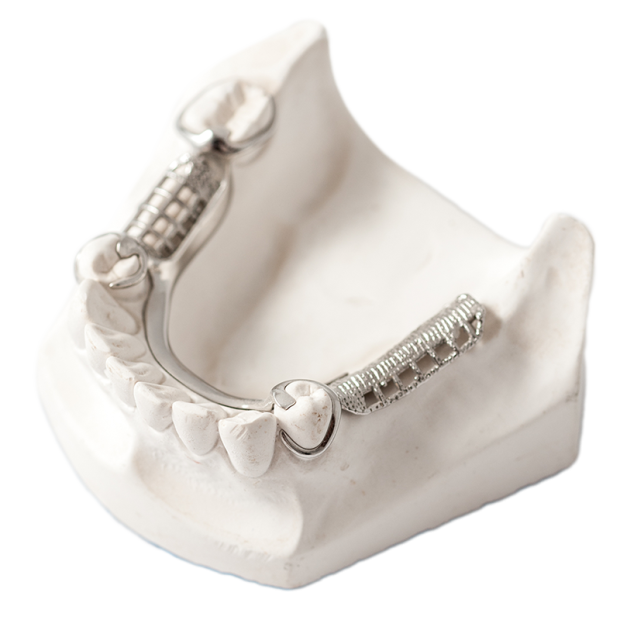 Dental Bridge