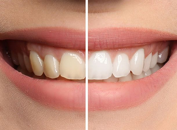 Teeth Whitening