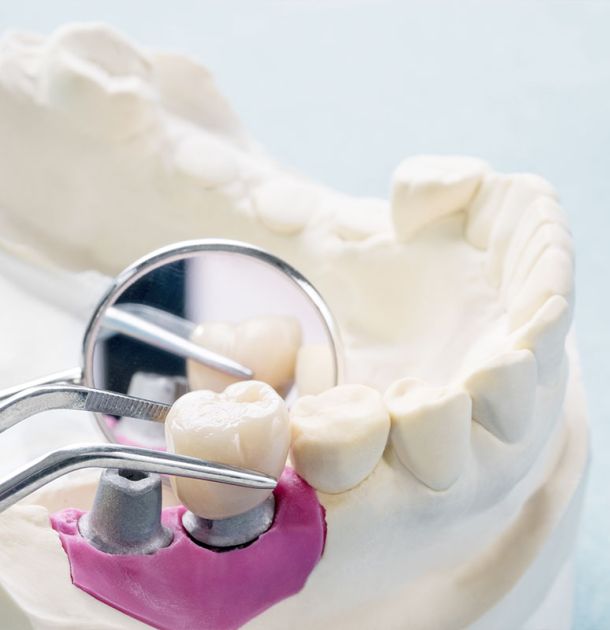 Dental Implants Tijuana