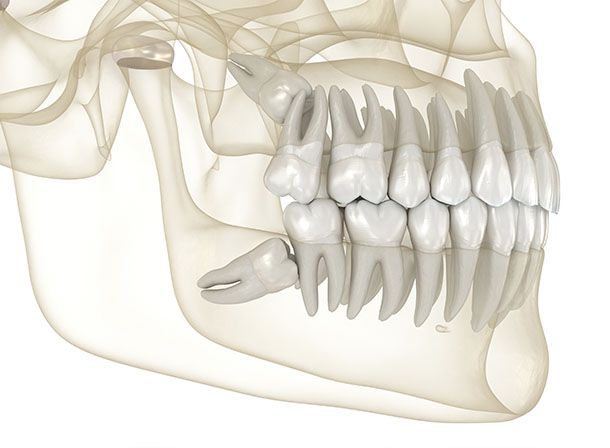 Wisdom Teeth Extraction