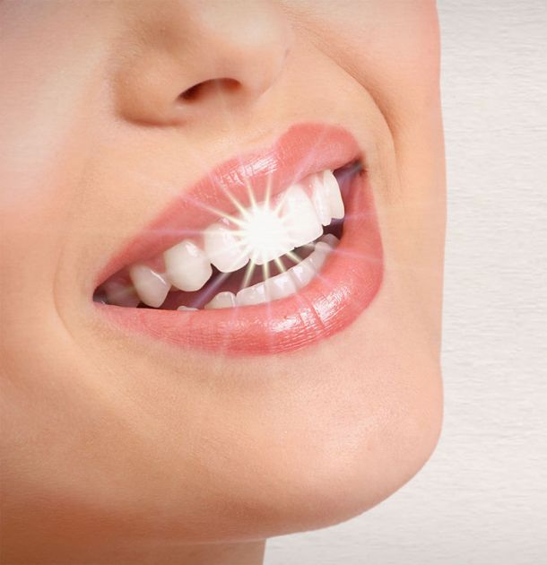 Teeth Whitening Tijuana
