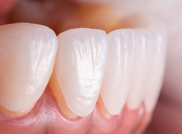 Porcelain Veneers