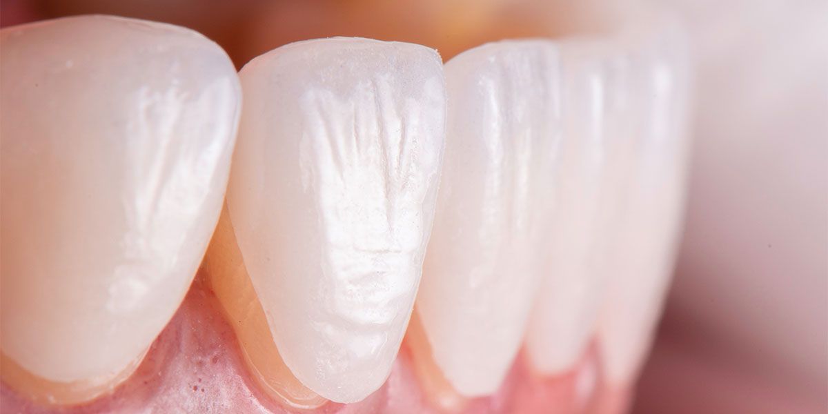 Dental Porcelain Veneers | Tijuana
