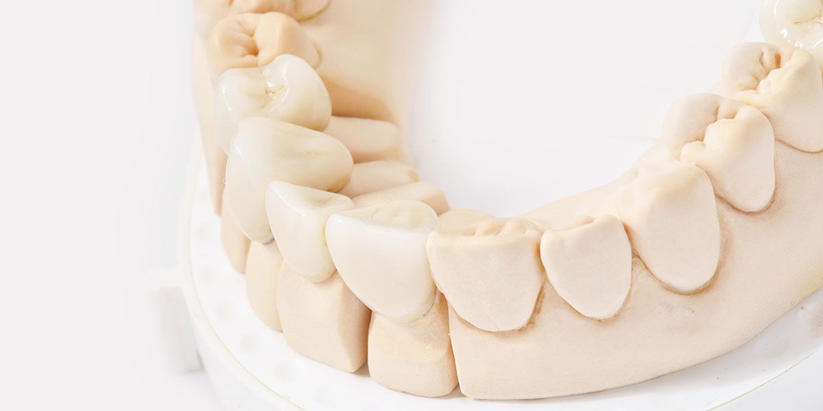 Smile Design | Tijuana Dentist