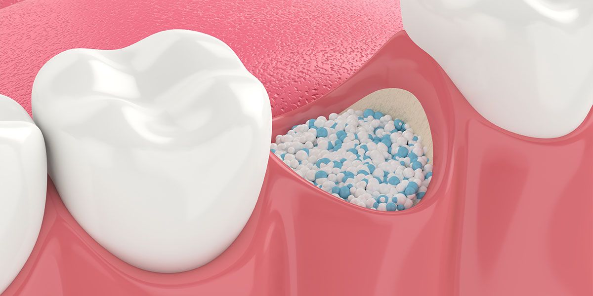 Dental Bone Graft | Tijuana