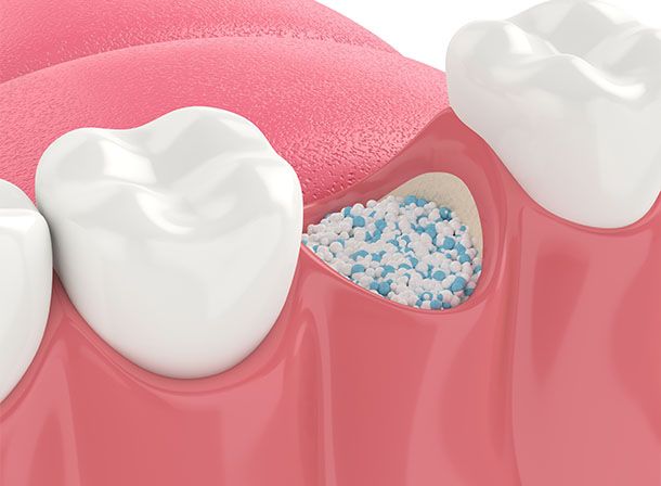 Dental Bone Graft