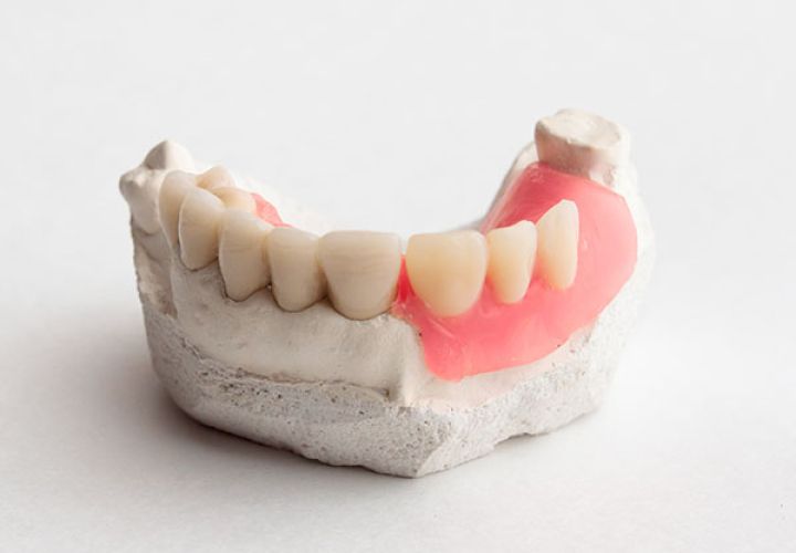 Dental Bridge