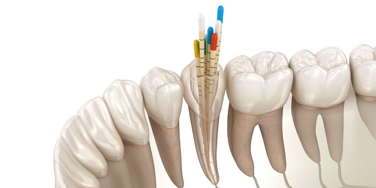 Root Canal Therapy | Tijuana