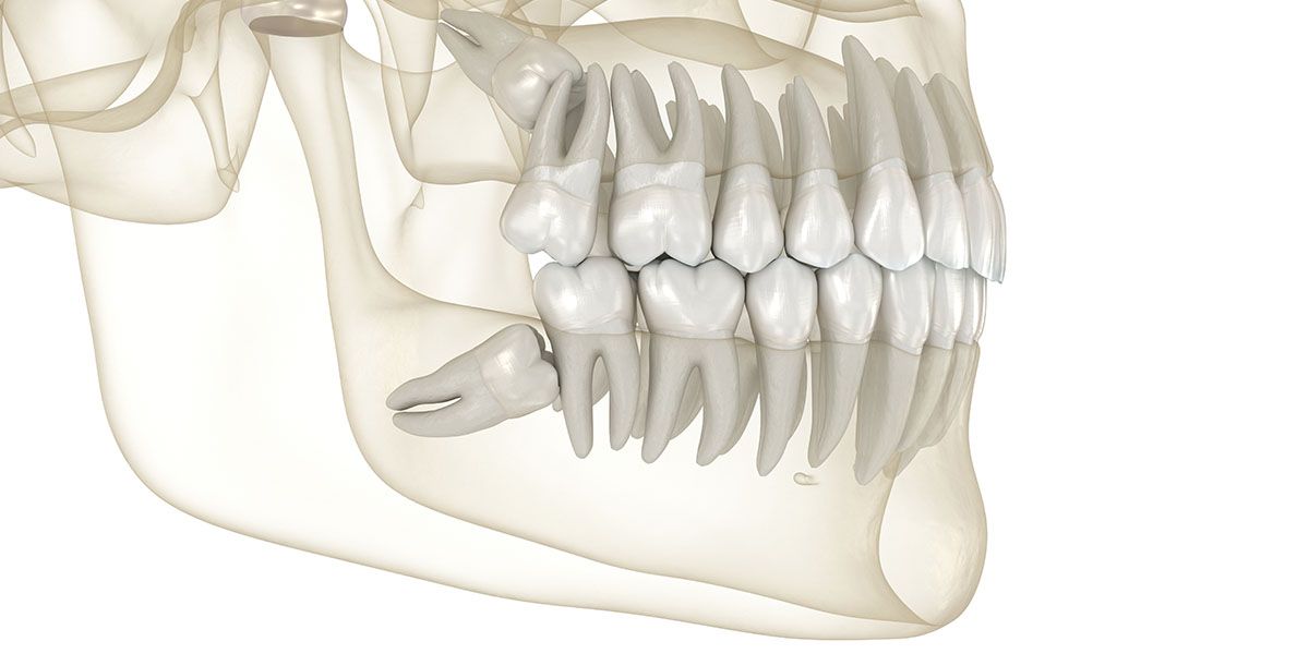 Wisdom Teeth Extraction | Tijuana