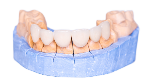 Dental Model | Tijuana Dentist