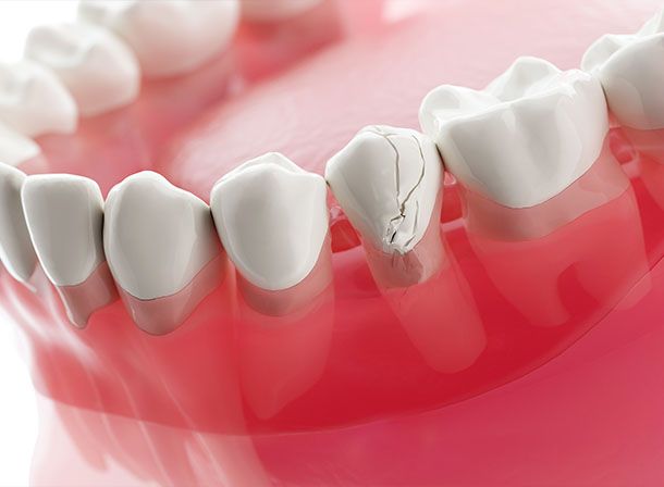 Resin Composite Fillings