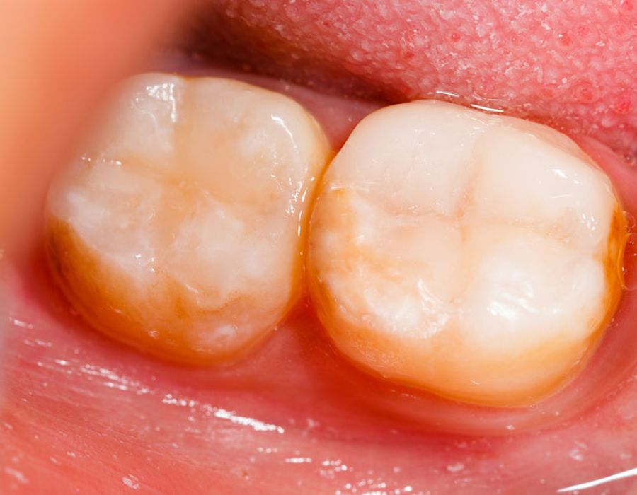 Resin Composite Fillings | Tijuana