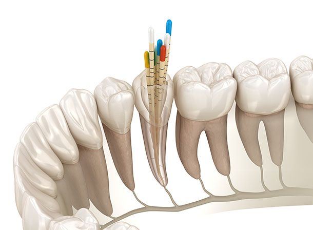 Root Canal Therapy