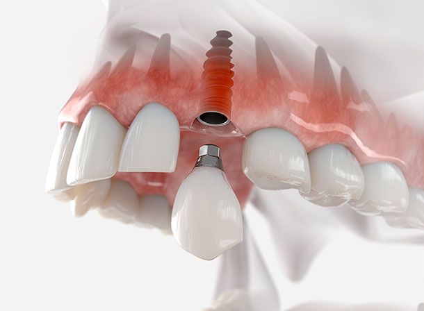 Dental Implants