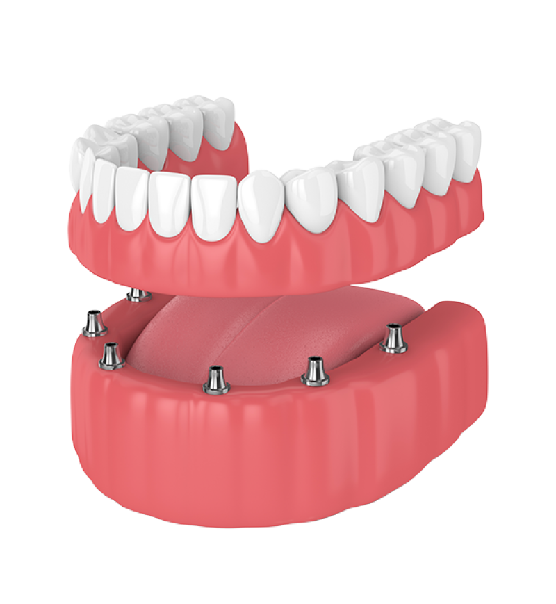 Non-Removable Denture | Tijuana