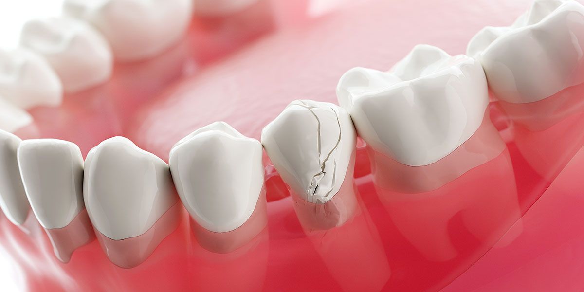 Resin Composite Fillings | Tijuana